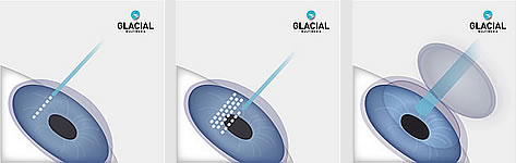 Blade-free LASIK