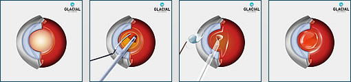 cataract surgery