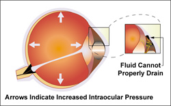 Glaucoma