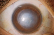 corneal scar