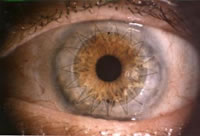 corneal transplant