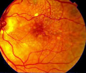 Macular Degeneration Treatments