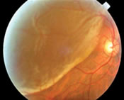 Retinal Detachment